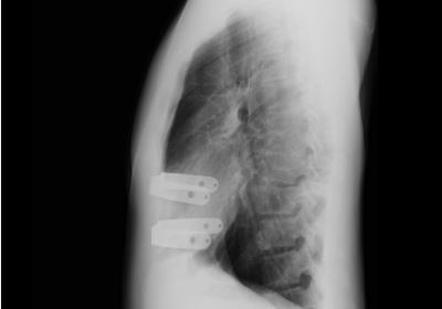 漏斗胸手術後の横からのレントゲン写真